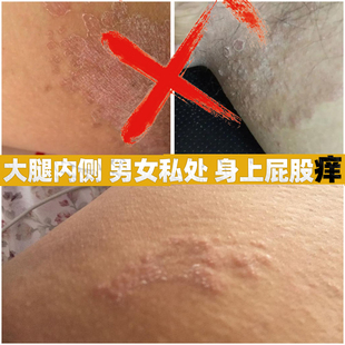 阴囊瘙痒去潮湿男士私处睾丸痒大腿内侧止抑菌膏下体肛门瘙痒湿痒