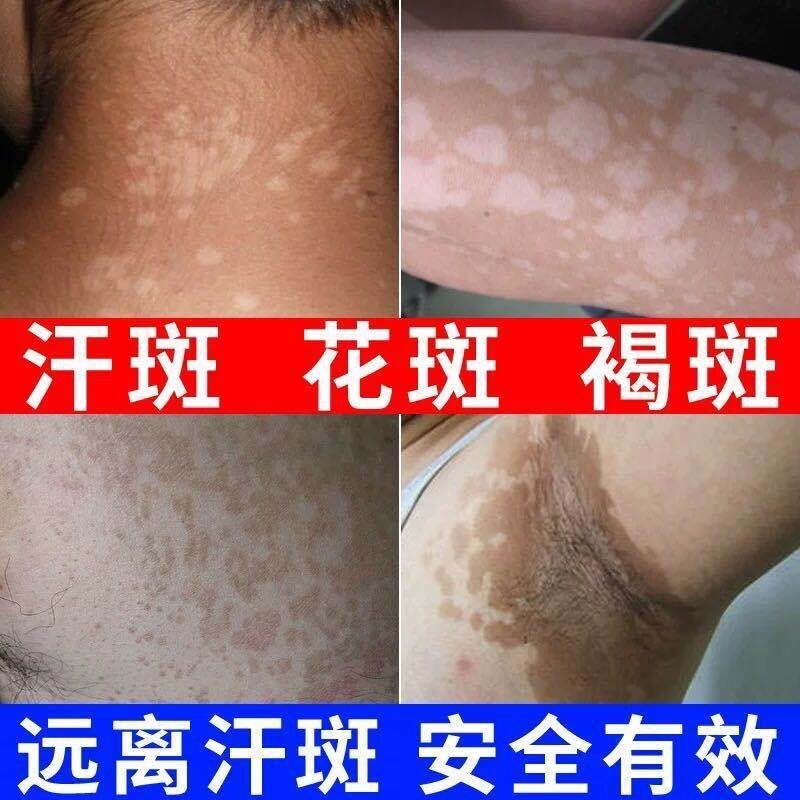 治玫瑰糠疹花斑药膏成人皮肤外用汗斑花斑廯汗藓汗斑