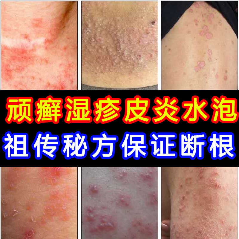 牛皮癣专用药膏专治湿疹皮肤瘙痒外用银屑病止痒断根铜钱癣特效药