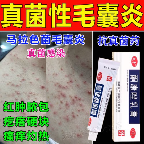 【太平】酮康唑乳膏2%*10g*1支/盒马拉色菌药毛囊炎专用药膏脂溢性皮炎前胸后背真菌