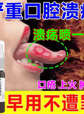 口腔溃疡特专用效药上火嘴巴舌头烂内壁起泡疼痛白泡溃疡喷剂WM