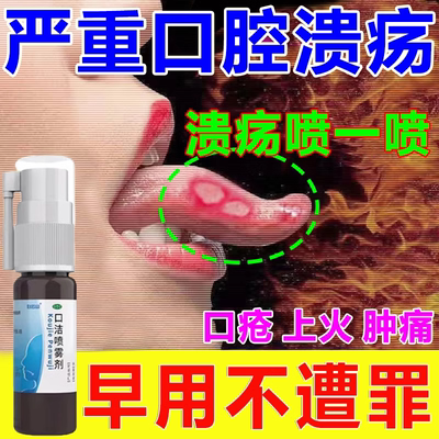 口腔溃疡特专用效药上火嘴巴舌头烂内壁起泡疼痛白泡溃疡喷剂WM