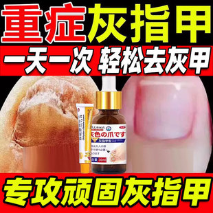 环吡酮擦剂搽剂茶灰指甲治疗专用药脚气甲沟炎治药水正品旗舰店xl