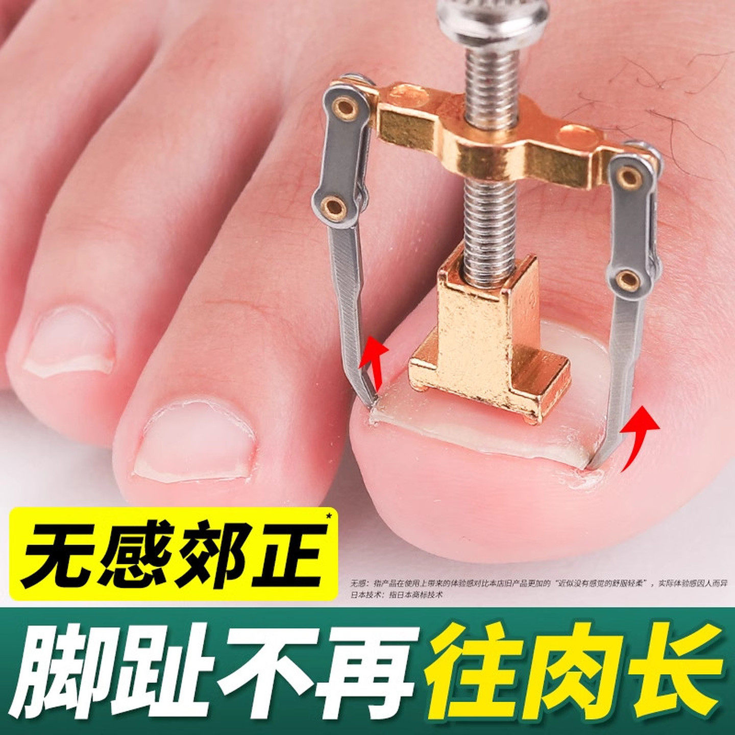甲沟嵌甲矫正器炎趾甲长肉里纠正修复卷甲拉正指甲盖修脚工具