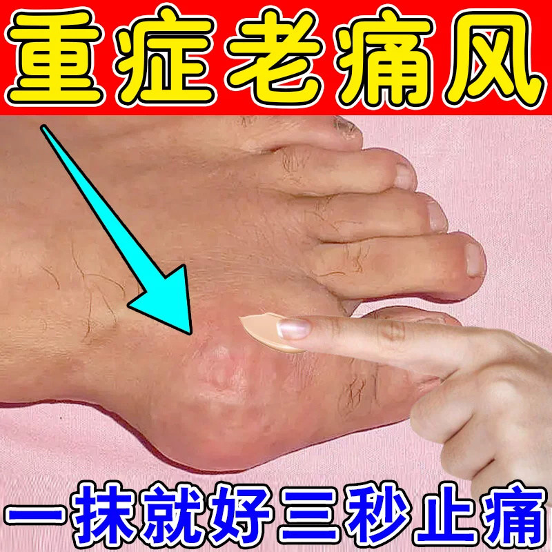 迪根 双氯芬酸钠缓释片尿酸高痛风降尿酸手关节炎特效药治痛风石