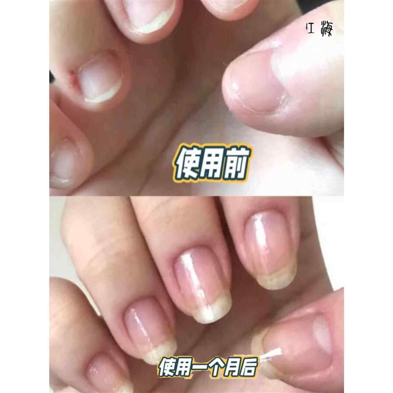速发宝宝戒吃手手套手瘾矫正器吸咬防吃手神器大拇指儿童戒手指套