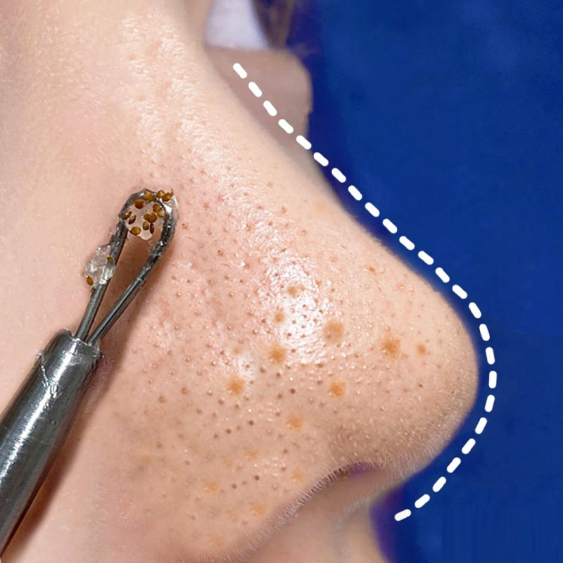 【毛孔吸尘器】清洁毛孔堵塞 深层清洁污垢 脸部脏东西统统消失