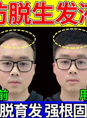 米诺地尔片非那雄胺1mg片男性激素脱发生发增发密发雄激素