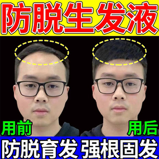 米诺地尔片非那雄胺1mg片男性激素脱发生发增发密发雄激素