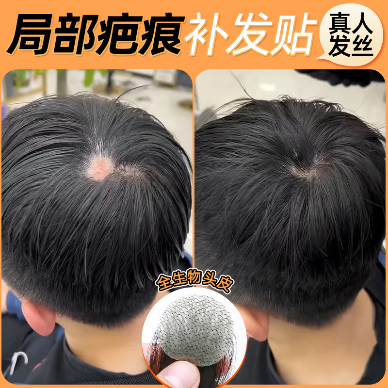 疤痕补发贴片男士假发头顶斑秃烧伤小面积生物头皮真发补发假发片
