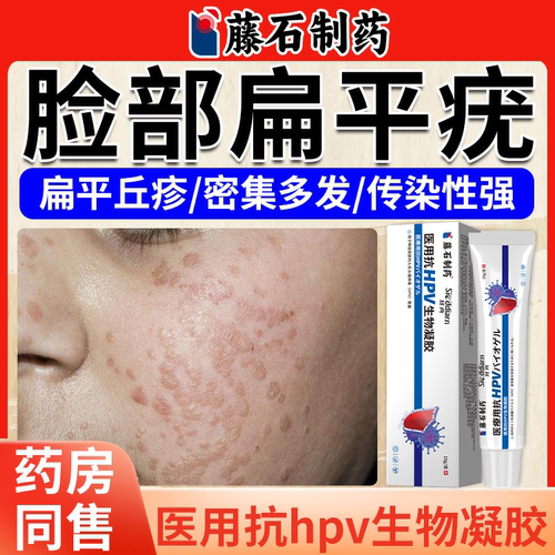 医用退热凝胶去扁平疣型瘊肉粒面颈根部专用膏干扰素b2YY