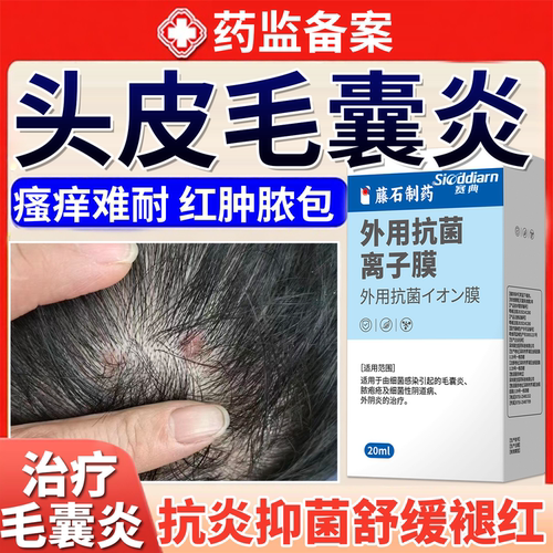 头皮毛囊炎长痘痘红疙瘩痒溢脂性搭专用洗发水除螨控油去屑止痒ON