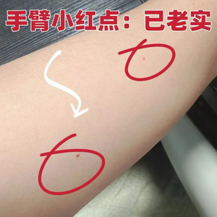 血管痣红痣樱桃状血管瘤血痣去除皮肤身上手臂长小红点创面护理YU