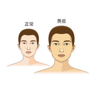 黄疸代谢检测 胆红素偏高 UGT1A1基因检测 Gilbert综合征基因检测