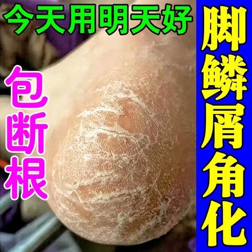 脚后跟干裂真菌感染脚裂脱皮脚上脚藓脚后跟手脚开裂专用修复药膏
