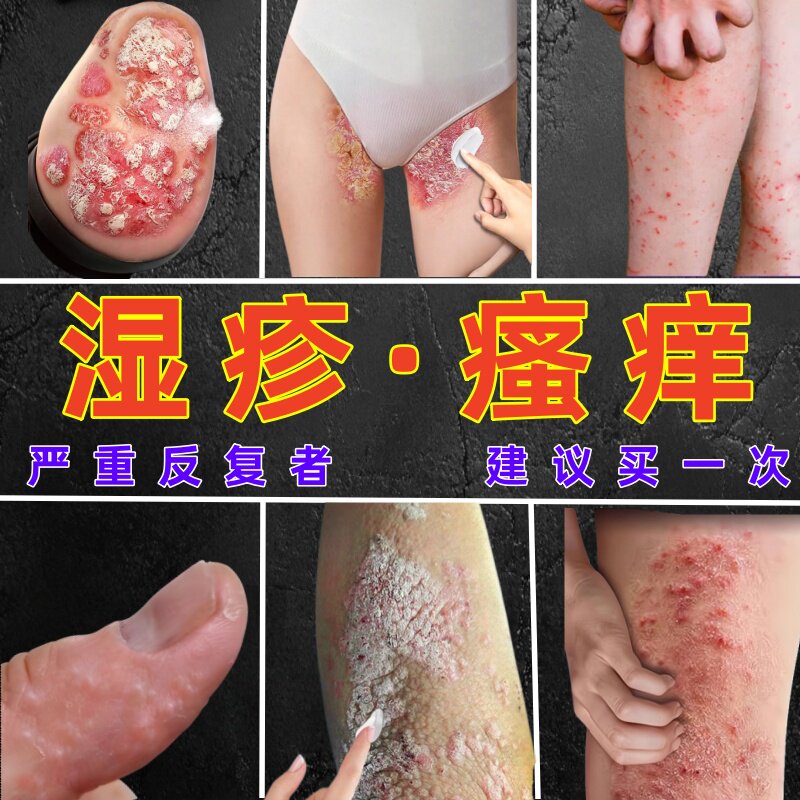 湿疹皮炎皮肤瘙痒疙瘩真感染凝胶