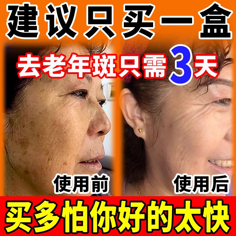 老年斑强力去除手部脸部去斑专用老人祛斑霜祛黄褐斑雀斑官方正品