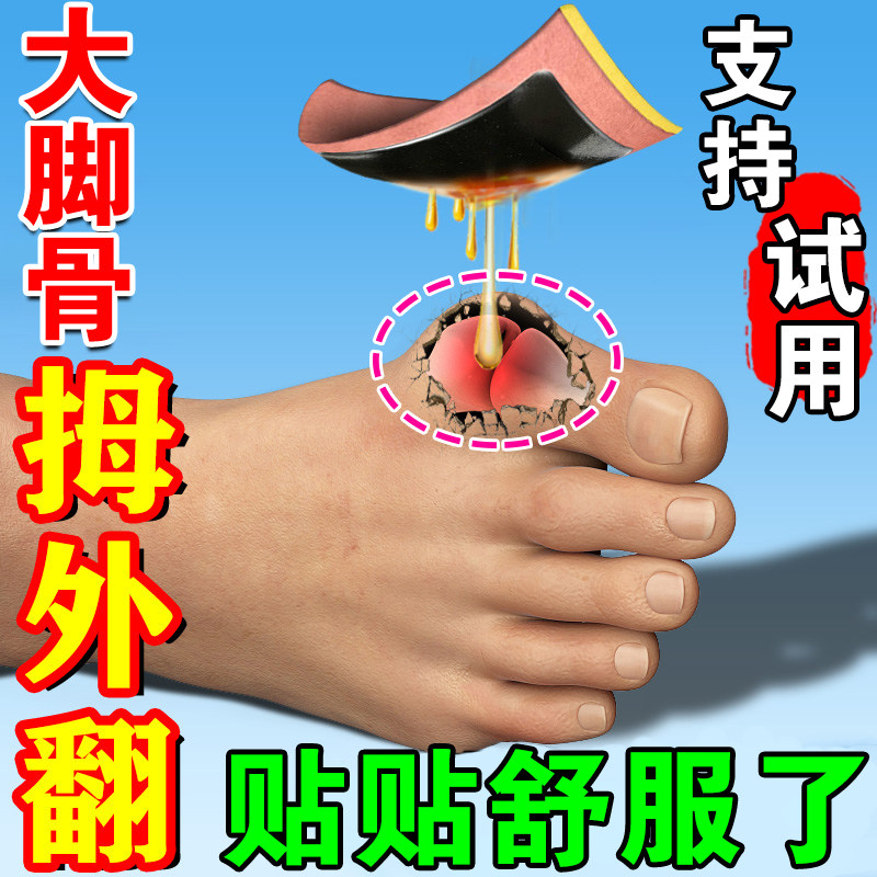 拇指外翻膏药贴矫正器女士大脚骨专拇囊用炎大母趾关节疼痛畸形肿_虎窝淘