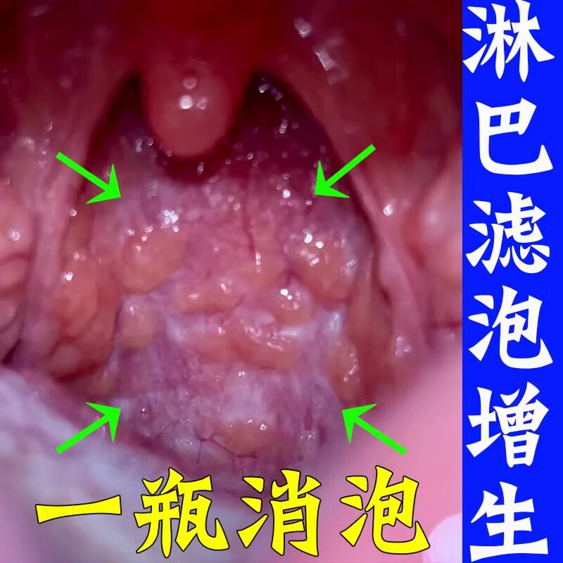 慢性咽炎咽喉炎咳嗽异物感喉咙有化痰咽扁进口除专用贴根喷剂