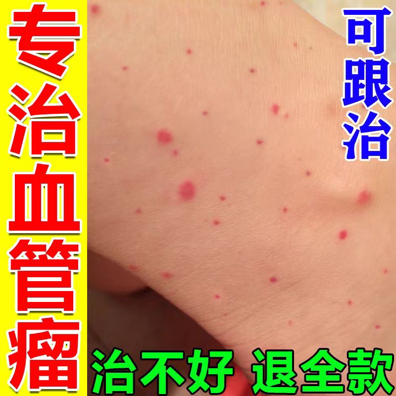 【专治血管瘤】祛血痣凝胶药膏