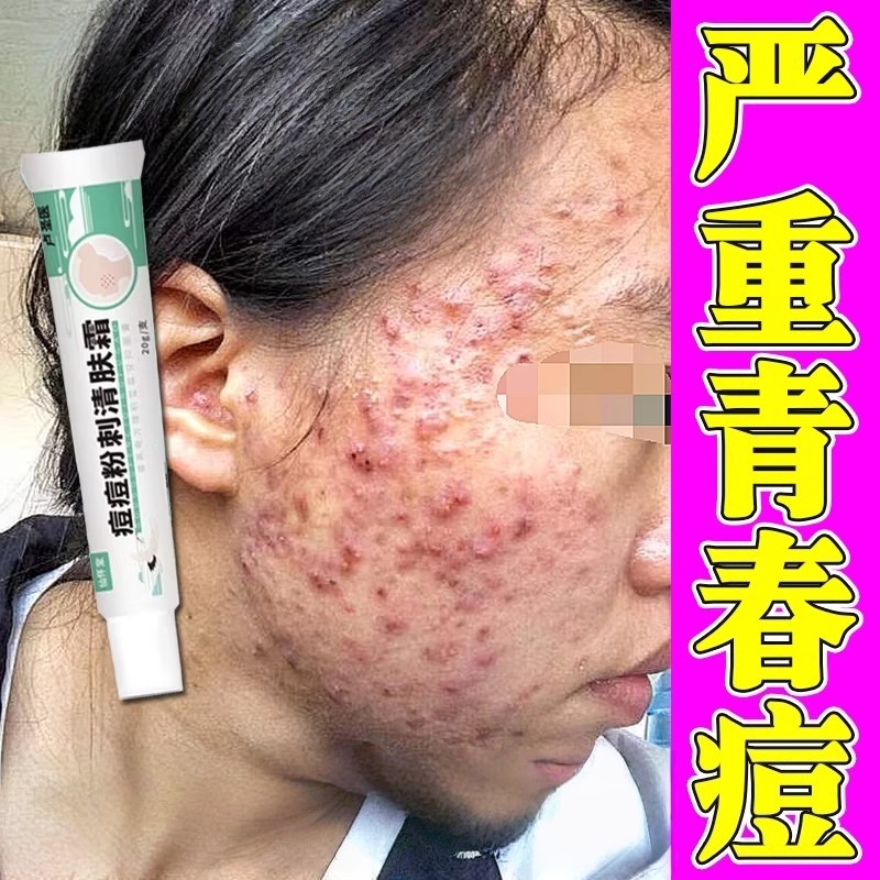 青少年治痘膏治痘正品青春痘初中生去豆豆祛痘印膏额头脸部长痘痘,洗护清洁剂/卫生巾/纸/香薰,乳液/面霜,淘宝优惠券,粉丝福利购,淘宝优惠卷