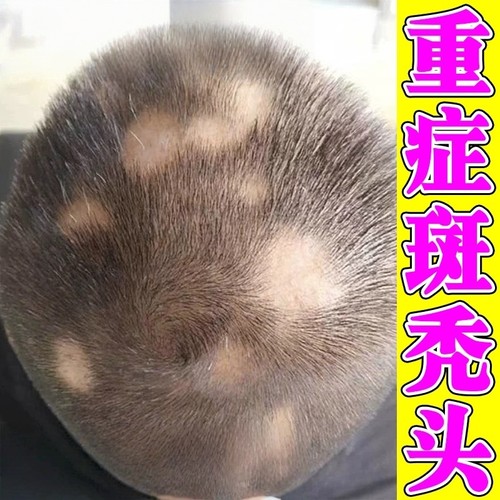 斑秃特鬼剃头药效防脱发严重专用洗发水一抹灵生姜生发液遮盖神器