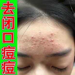去额头痘痘除痘膏儿童学生头部闭口粉刺起小疙瘩青春痘专用