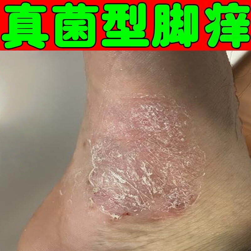脚痒药真菌感染脚后跟干裂脱皮角化型脚鳞屑脚踝红斑角质层厚痒用
