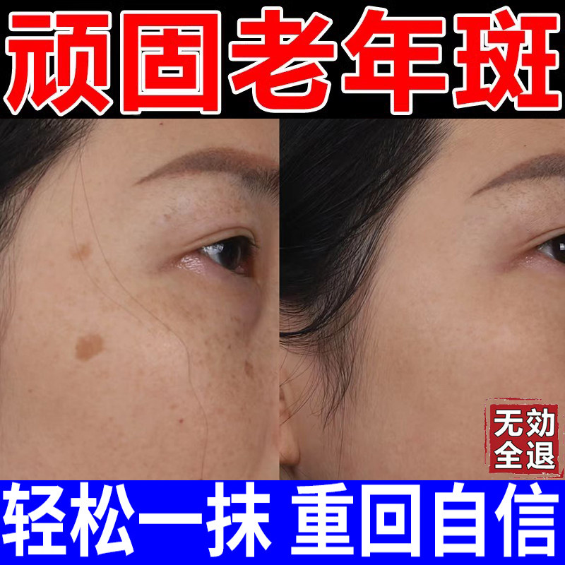 去斑祛黄褐斑雀斑膏官方正品专用药水一擦就掉黄芪霜老年斑一抹净
