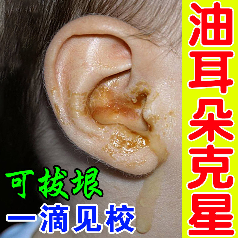 油耳朵治疗去油神器儿童耳屎清理耳痒软化清洁器中耳炎发炎滴耳液