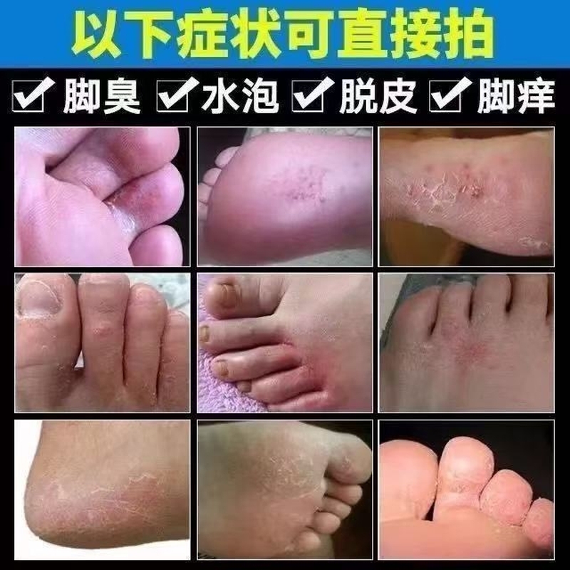 脚气喷雾止脱皮痒杀菌去真菌感染专用除臭脚出汗糜烂脚丫脚趾缝根