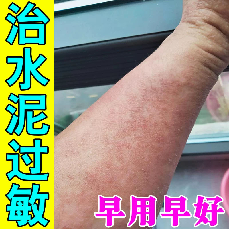 专冶皮肤刺痒过敏水泥痒药水泥工地建筑专用手痒干裂红肿草本乳膏
