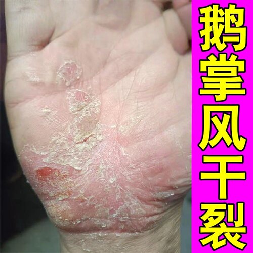 鹅掌风专用干裂蜕皮手膏烂手鹅掌风硬皮裂口修复