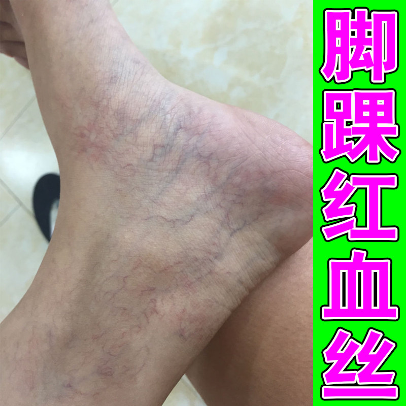 脚上腿上有红血丝静脉曲张冷敷凝胶去脚腕毛细血管扩张药