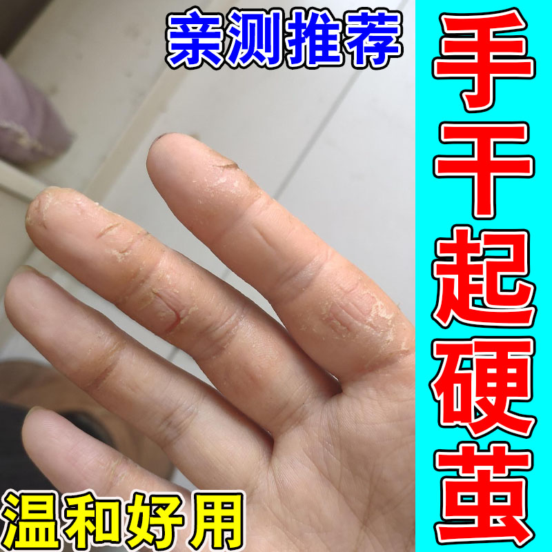 手指尖细小裂口连片手指干燥起皮粗糙冷风天干裂换季手干粗糙