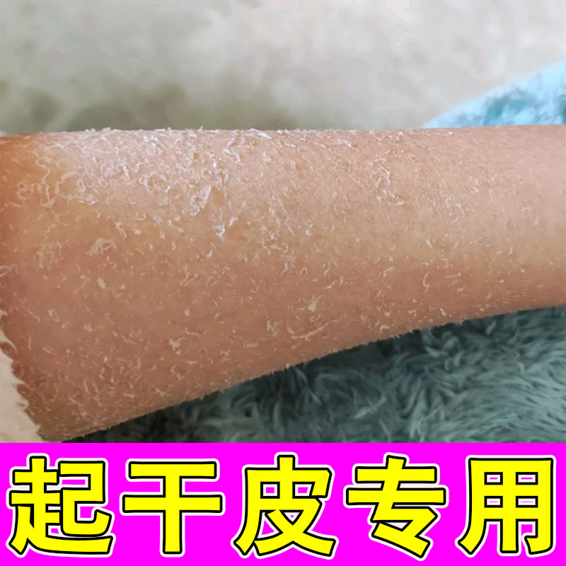 小腿上干燥起皮小腿皮肤粗糙干裂学生成人身上掉皮屑鱼鳞去死皮