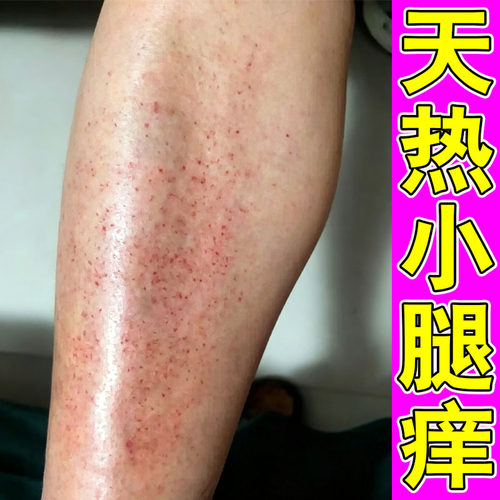 腿上冒出成片小疙瘩和红疙瘩天热腿痒起红斑疙瘩