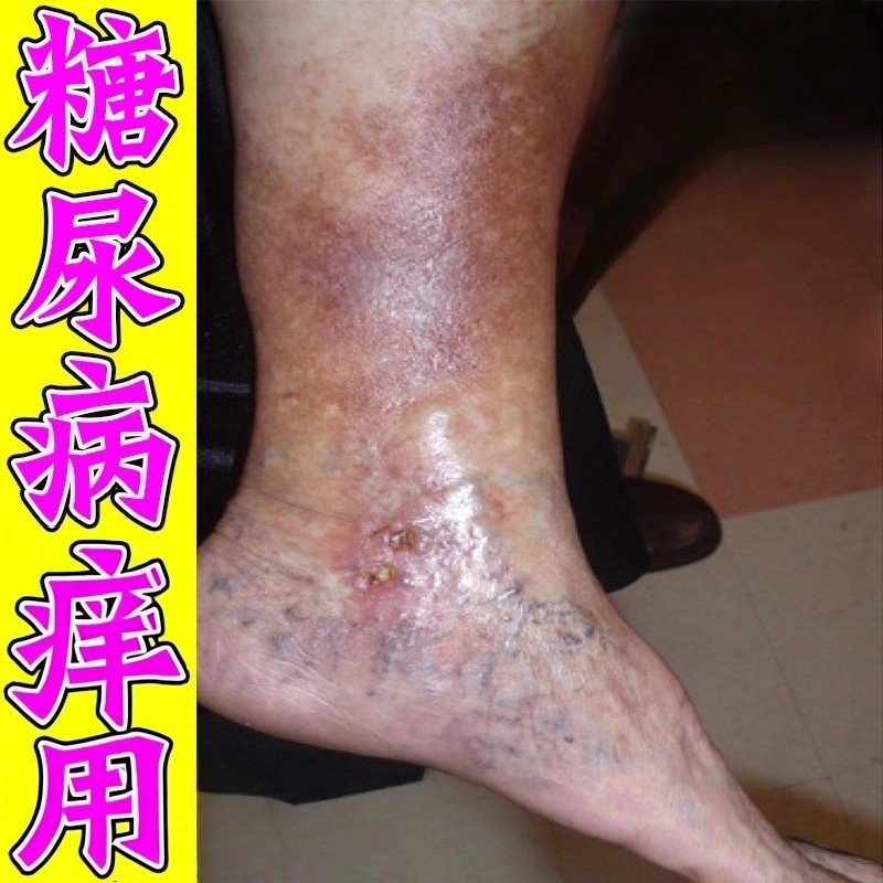 糖尿病感染性痒皮肤烂痒