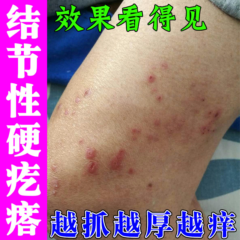 冶结节性痒膏顽固性疙瘩痒全身痒皮肤红斑干痒皮肤硬疙瘩起皮痒