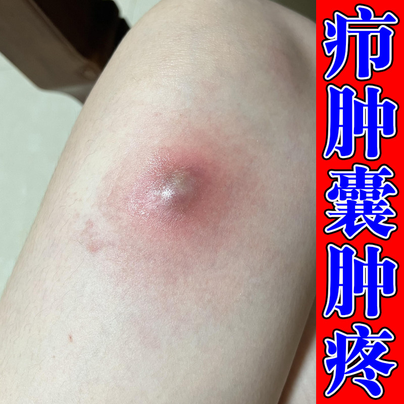 改善上火引起皮肤红肿大包硬结皮下囊肿凸起红肿硬疙瘩疼舒缓膏