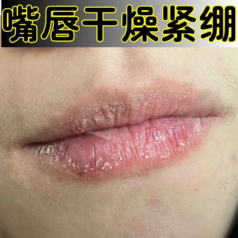 嘴唇干燥起皮唇膏嘴过敏紧绷灼热脱屑性唇周发炎枇糠样白色鳞屑药
