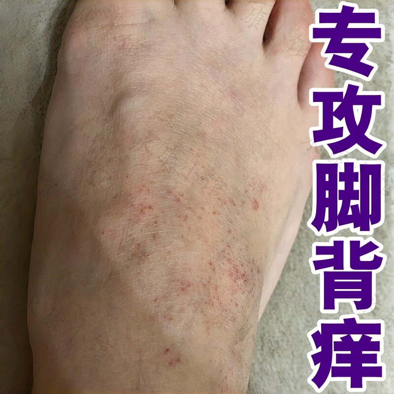 秋冬季节脚背溃烂痒外用膏脚过敏性脱皮脱屑气脚汗状疱泡疹痒止药