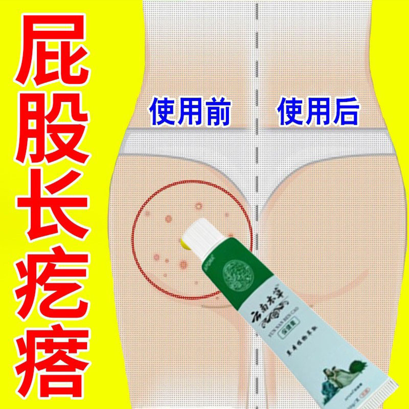 大人屁股红的膏臀部痒起热疙瘩久皮肤消毒护理（消）