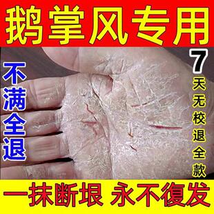 鹅掌风特效药干裂脱皮止痒抑菌手脚癣汗疱疹真菌感染专用手气药膏