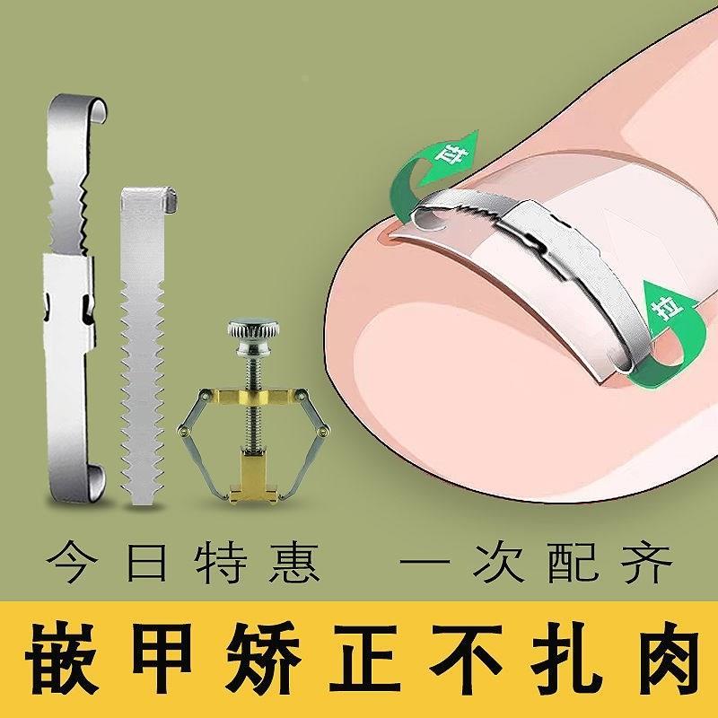 指甲往肉里长专用正甲扣大脚趾甲沟嵌甲矫正器家用护理炎贴片神器