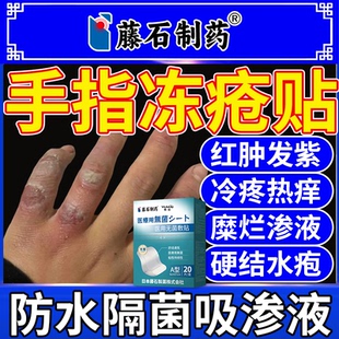 手冻伤手指冻疮贴医用级冬季手干裂贴冻疮专用冻疮膏止痒冻伤膏VV