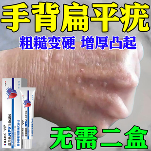 手背扁平疣软膏去疣瘊子专丝状小肉粒用药房同售搭干扰素b2凝胶KV