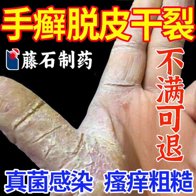 手癣膏脱皮干裂真菌感染手足藓喷雾剂鹅掌风专用搭膏药贴起水泡KD