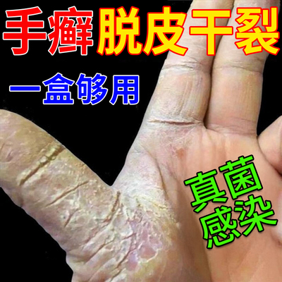 手癣膏脱皮干裂皮肤真菌喷雾