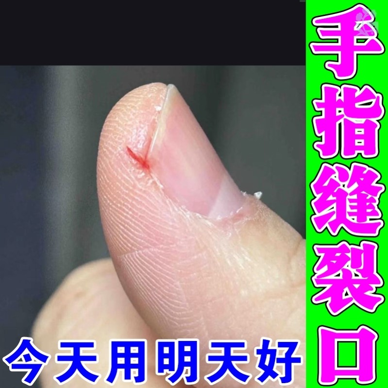 手指头裂口子干裂修复霜秋冬季指甲缝开裂脱皮疼痛防皲裂愈合膏